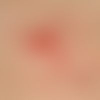 Pustel: kleine follikuläre Pusteln auf&nbsp;geröteter Umgebung.

