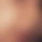 Pityrosporumfollikulitis des Säuglings. Akneiforme Papeln im Wangenbereich bei einem 10-Monate al...