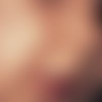 Pityrosporumfollikulitis des Säuglings. Akneiforme Papeln im Wangenbereich bei einem 10-Monate al...