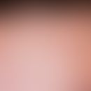 Eosinophile pustulöse Follikulitis:&nbsp;mäßig juckende, urtikarielle Papeln und Plaques; in Stir...