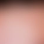 Eosinophile pustulöse Follikulitis:&nbsp;mäßig juckende, urtikarielle Papeln und Plaques; in Stir...