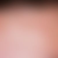 Eosinophile pustulöse Follikulitis:&nbsp;mäßig juckende, urtikarielle Papeln und Plaques; in Stir...
