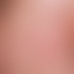 Eosinophile pustulöse Follikulitis: Nahaufnahme, unscharf begrenzte Erytheme mit stecknadelkopfgr...