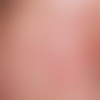 Eosinophile pustulöse Follikulitis: Nahaufnahme, unscharf begrenzte Erytheme mit stecknadelkopfgr...