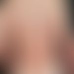 Eosinophile pustulöse Follikulitis:&nbsp;multiple, chronische, seit 6 Monaten rezidivierend verla...