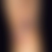 Pyodermia vegetans: General view: Clearly putrid, round ulcerations as well as crusts and punctua...