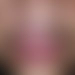 Pyoderma: acute, painful raised areas filled with yellow fluid (pustules) with central hair and s...
