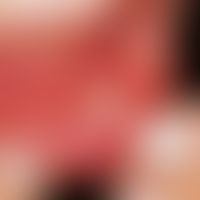 Pyostomatitis vegetans. Multiple, stecknadelkopfgroße bis kleinfingernagelgroße, schmerzhafte, st...