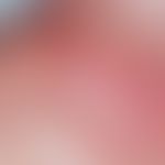 Radiodermatitis chronica. reticular vascular ectasia between flat, whitish atrophy in the area of...