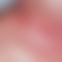 Radiodermatitis chronica. reticular vascular ectasia between flat, whitish atrophy in the area of...