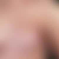 Chronic radiodermatitis. blurred hyperpigmentation on tight, atrophic skin with single ulceration...
