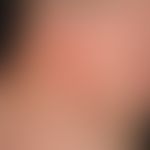 Raupendermatitis: Streifige, heftig juckende und brennende Dermatitis. 
