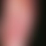 Reiter's syndrome: flat reddened plaques with large, in places confluent pustules and coarse lame...