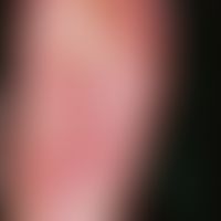 Reiter's syndrome: flat reddened plaques with large, in places confluent pustules and coarse lame...