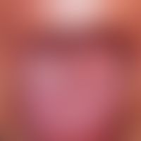 Reiter's syndrome: pronounced lingua plicata; during a relapsing activity, tongue burning with re...