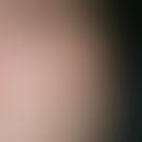Irritant acanthomas: Nodules induced by chronic physical stimulation (here pressure), broad-based...