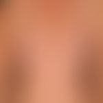 REM-Syndrom: In typischer Lokalisation positionierte Muzinose der Haut mit teils flächigen teils ...
