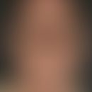 Retikuloid, aktinisches. Im Bereich der belichteten Areale des Gesichtes und Halses lokalisierte,...