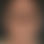 Retikuloid, aktinisches. Im Bereich der belichteten Areale des Gesichtes und Halses lokalisierte,...
