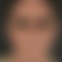 Retikuloid, aktinisches. Im Bereich der belichteten Areale des Gesichtes und Halses lokalisierte,...