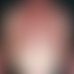 Retikuloid, aktinisches. Im Bereich der belichteten Areale lokalisierte, großflächige, raue (schu...