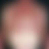Retikuloid, aktinisches. Im Bereich der belichteten Areale lokalisierte, großflächige, raue (schu...