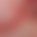 Reticulosis, pagetoid, for several years slowly migrating, partly anular, partly garland-shaped, ...