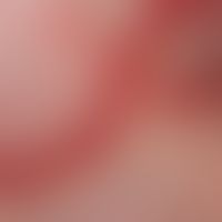 Reticulosis, pagetoid, for several years slowly migrating, partly anular, partly garland-shaped, ...