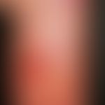 Reticulosis, pagetoid, long-standing, sharply defined, punched out ulcerations in blurred red pla...