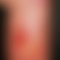 Reticulosis, pagetoid, long-standing, sharply defined, punched out ulcerations in blurred red pla...
