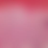 reticulosis, pagetoid. acanthoid widened epidermis, papillomatosis, pagetoid penetration of the e...