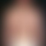 Reticulosis pagetoid, disseminated type (Ketron and Goodman). progressive clinical picture existi...