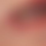 Rhagade in chronic actinic cheilitis: A deep, narrow, elongated defect of the lower lip which has...