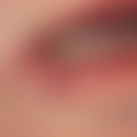 Rhagade in chronic actinic cheilitis: A deep, narrow, elongated defect of the lower lip which has...