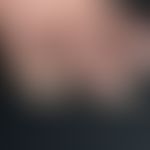Rhagade. 75-year-old patient with a hyperkeratotic ?fingertip eczema? that has been present for y...