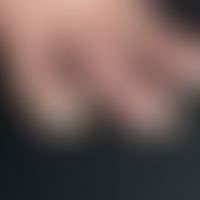 Rhagade. 75 Jahre alter Patient mit einem seit Jahren bestehenden, hyperkeratotischen ?Fingerkupp...