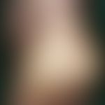 Rhagade: Recurrent, painful, deep, extremely schematic skin tear in the hyperkeratotic skin of th...