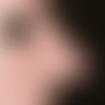 Rhinophyma, extensive sebaceous gland and reactive epithelial hyperplasia in the area of the nose...