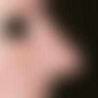 Rhinophyma, extensive sebaceous gland and reactive epithelial hyperplasia in the area of the nose...