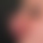 Rhinophyma (preoperative). decades of existing, so far untreated rhinophyma in a 72-year-old pati...