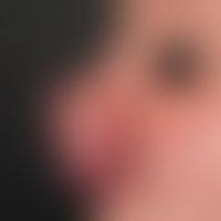 Rhinophyma (preoperative). decades of existing, so far untreated rhinophyma in a 72-year-old pati...