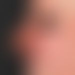 Rhinophyma (postoperative):Survey image to document the clinical course after combination treatme...