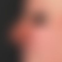 Rhinophyma (postoperative):Survey image to document the clinical course after combination treatme...