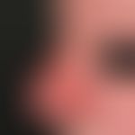 Rhinophyma (postoperative): Survey image to document the clinical course after combined treatment...