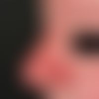 Rhinophyma (postoperative): Survey image to document the clinical course after combined treatment...