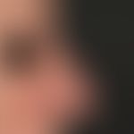 Rhinophyma. 1 - 2 years of persistent, distinct shape disturbance of the nose in an 81-year-old f...