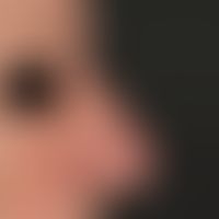 Rhinophyma. 1 - 2 years of persistent, distinct shape disturbance of the nose in an 81-year-old f...