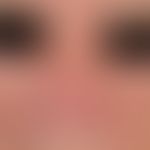 Rhinophyma. Disturbance of the shape of the nose due to diffuse, rather flat phymogenesis.
