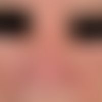 Rhinophyma. Disturbance of the shape of the nose due to diffuse, rather flat phymogenesis.
