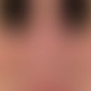 Rhinophym. diffuse shape disorder of the nose due to diffuse, partly flat, partly bumpy phym form...